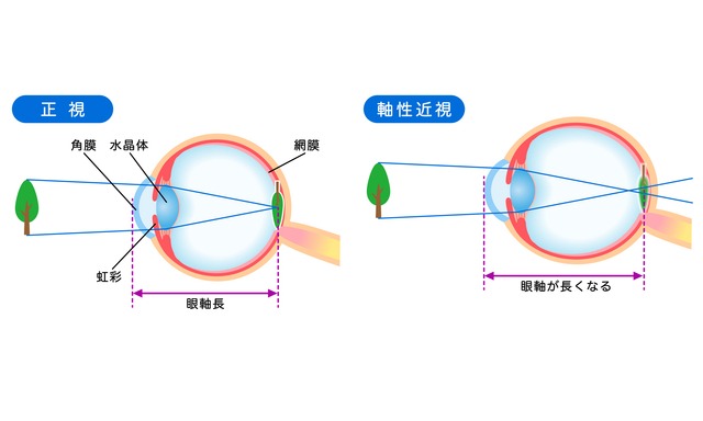①成長期の視力低下は「眼軸の伸び」によるもの