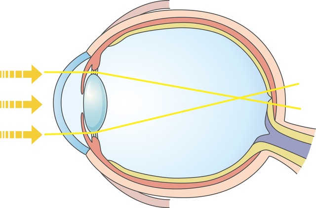 なぜ近視は進行し続ける？ 眼軸長の伸展について：目は環境に合わせて形を変える！
